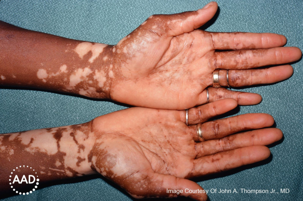 Vitiligo on dark skin .