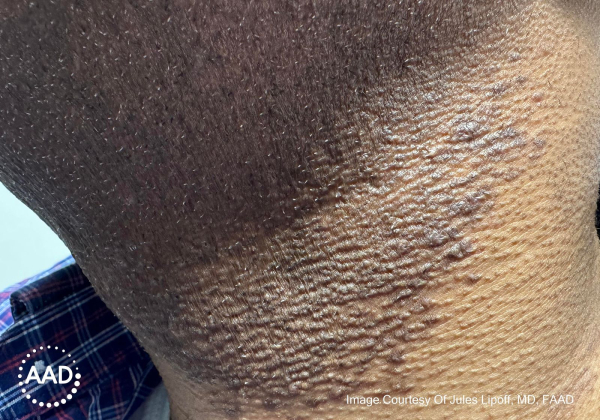 Razor bumps or Pseudofolliculitis barbae on Black skin