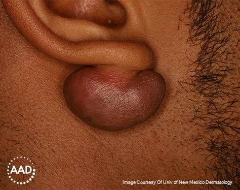 Keloid on ear on brown skin